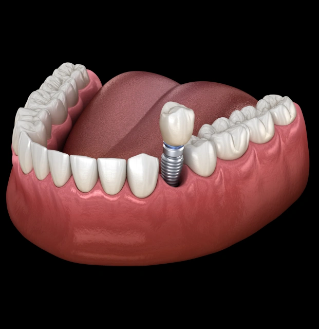 Dental implant model showing tooth replacement with artificial crown and fixture in gum tissue.