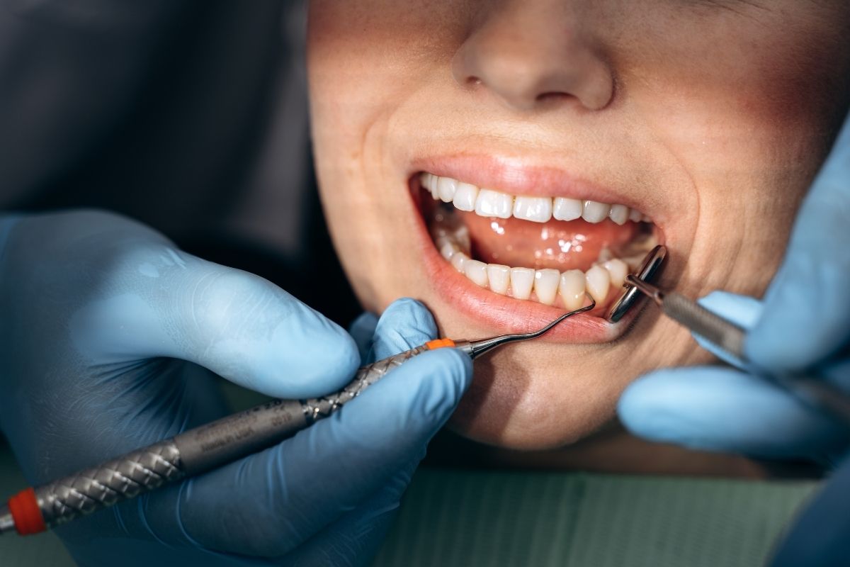 veneers in Lenexa
