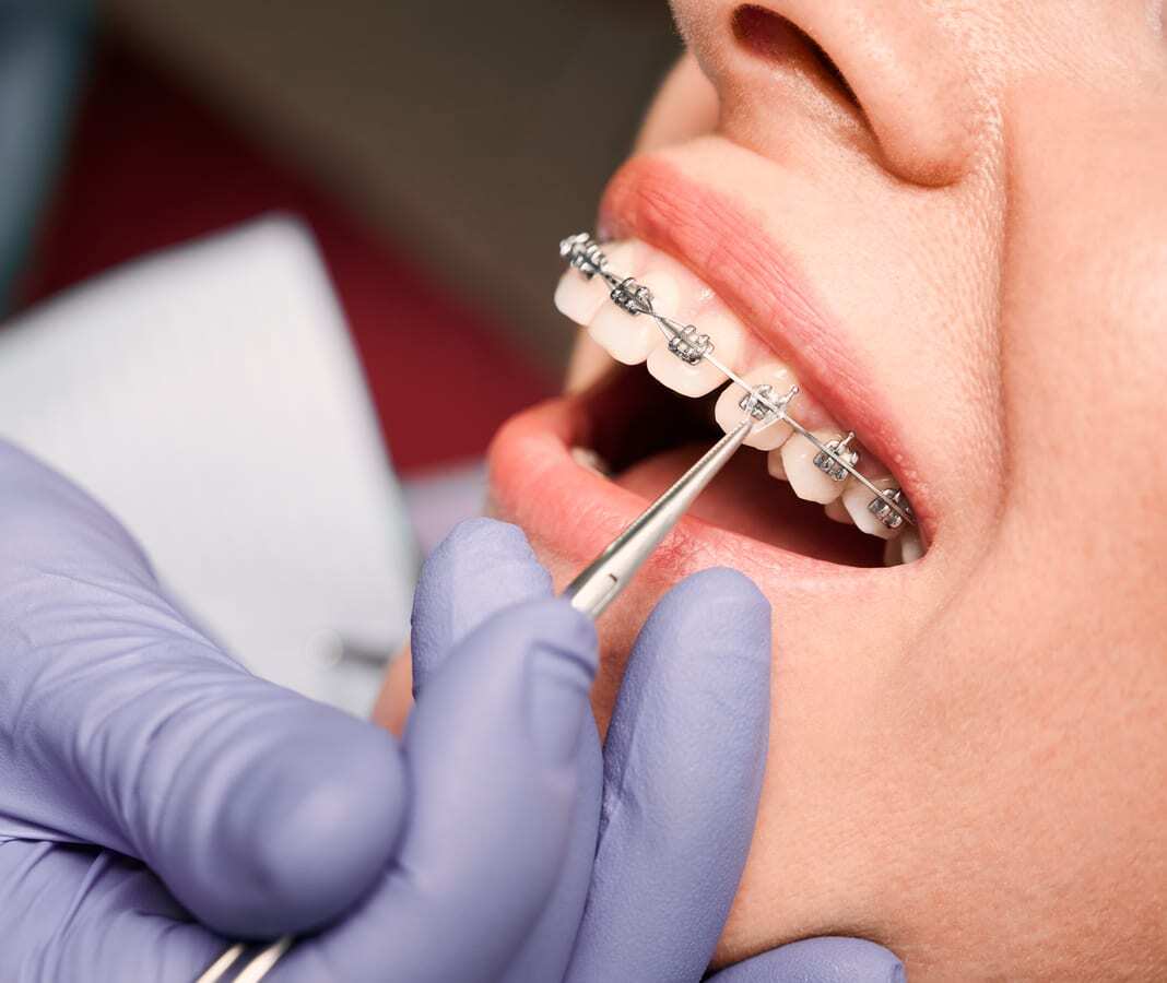 Dental hygienist adjusting braces on patient at dental office in Lenexa, Kansas.